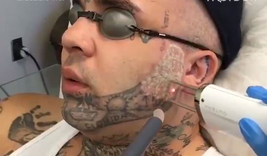 Uma nova técnica pra tirar tatuagem da cara